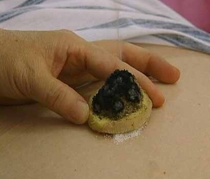 艾灸中的隔姜灸及其主治病症[点击放大]